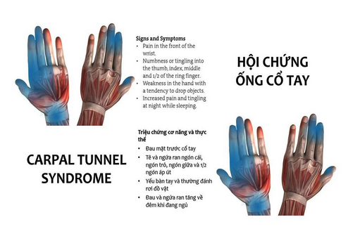 Dấu hiệu nhận biết hội chứng ống cổ tay
