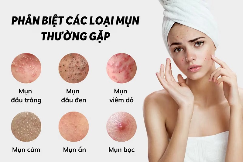 Các loại mụn thường gặp và cách nhận biết